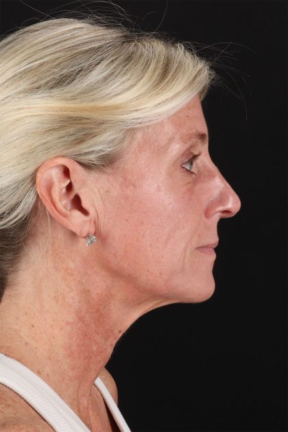 CO2 Laser Before & After Patient #11202