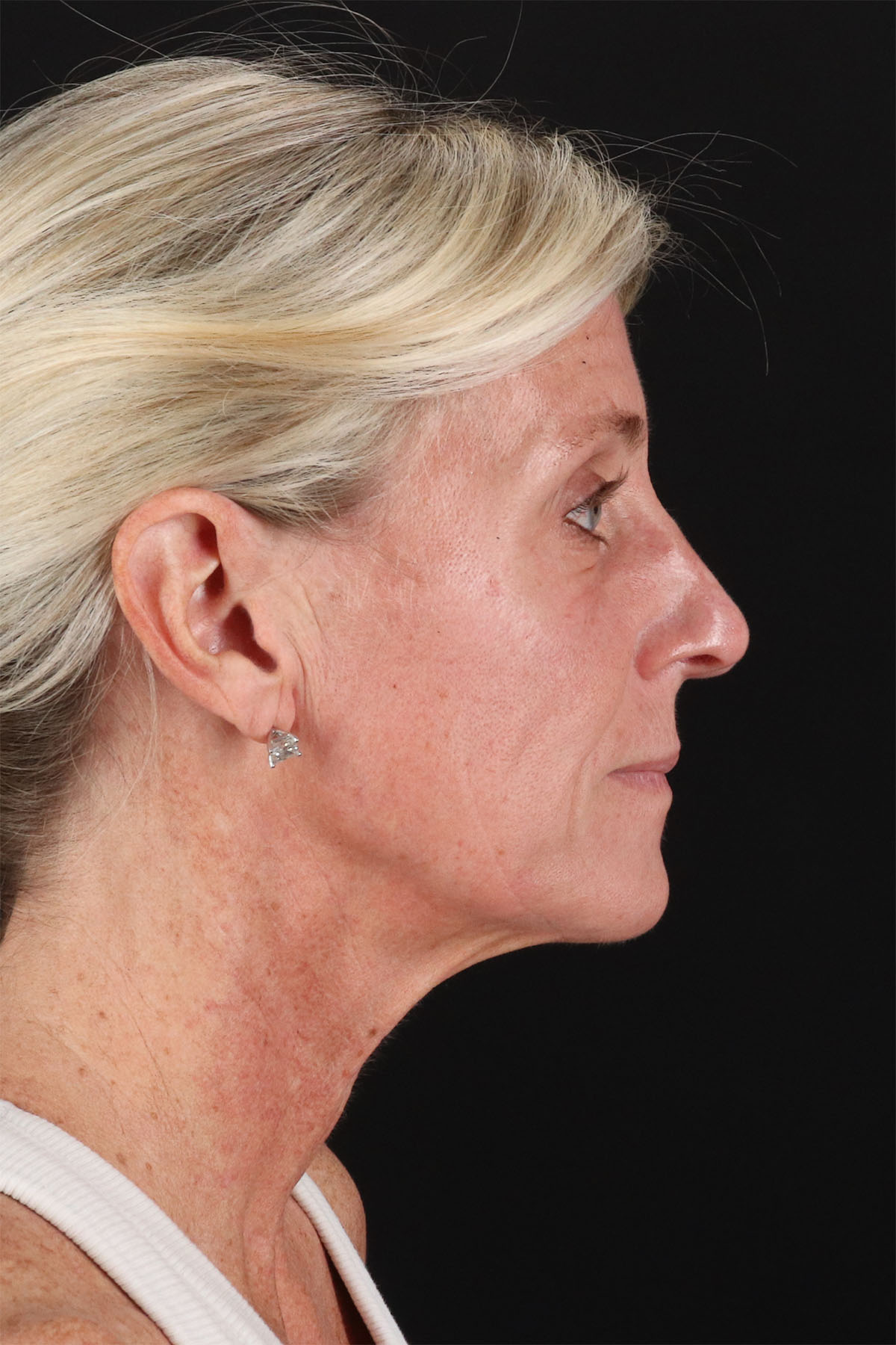 CO2 Laser Before & After Patient #11202