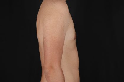 Female To Male Breast Before & After Patient #9981