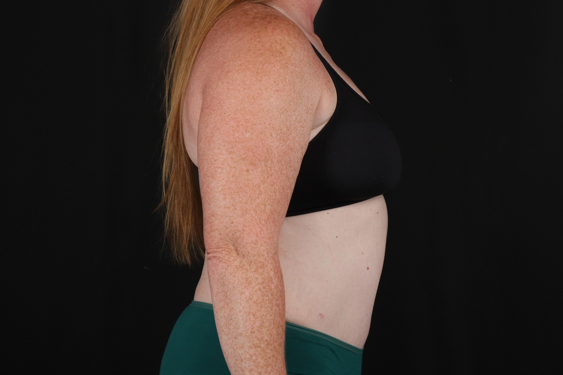 Abdominoplasty (Tummy Tuck) Before & After Patient #9980
