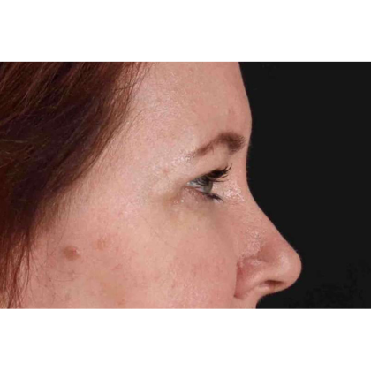 Brow Lift Before & After Patient #10859