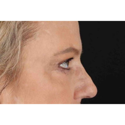 Brow Lift Before & After Patient #10848