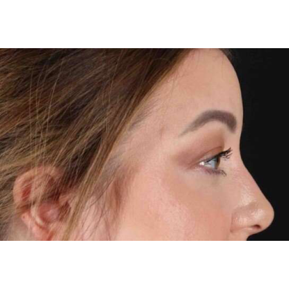Brow Lift Before & After Patient #10837