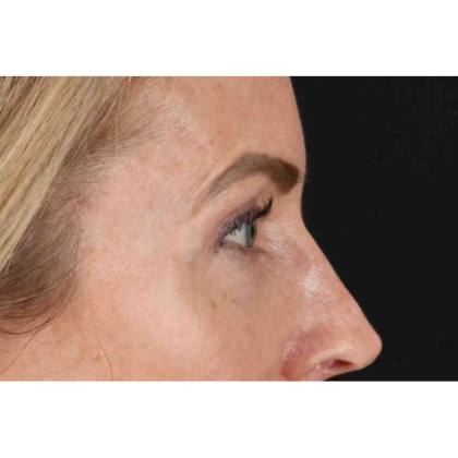 CO2 Laser Before & After Patient #10551
