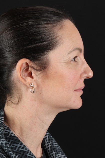 Chemical Peels Before & After Patient #11418