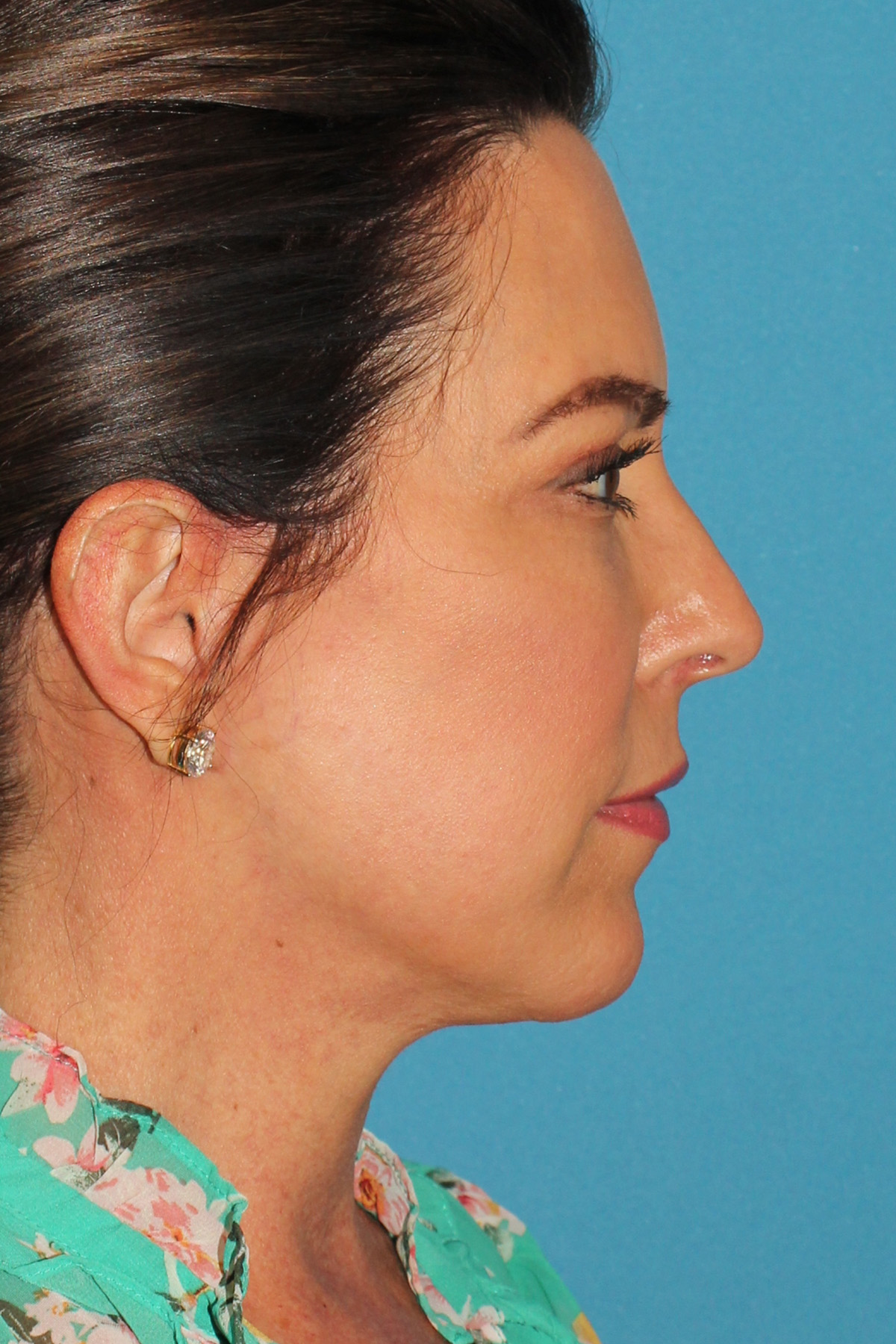 Chin Implant Before & After Patient #13684