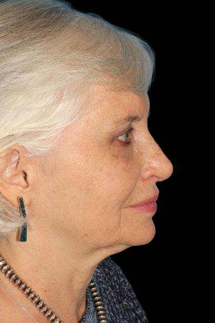 Lower Blepharoplasty Before & After Patient #12997