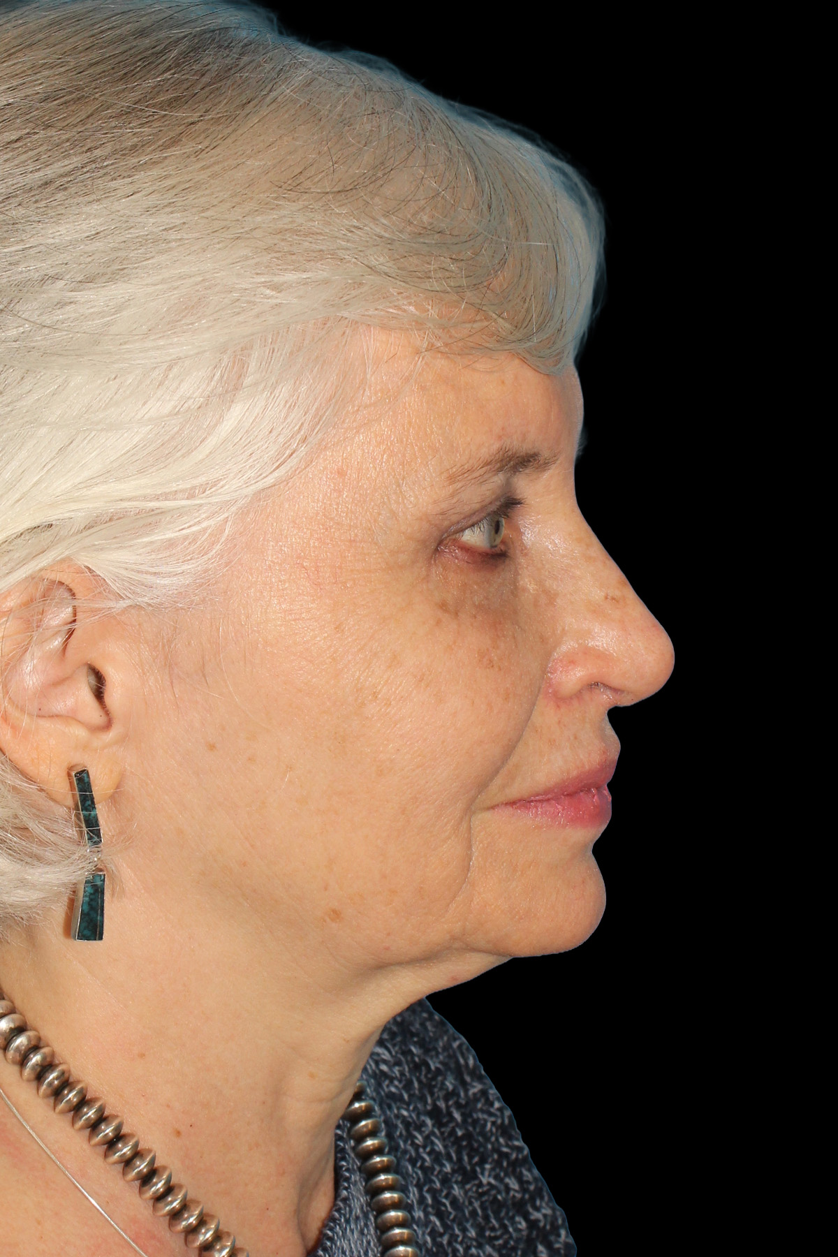 Lower Blepharoplasty Before & After Patient #12997