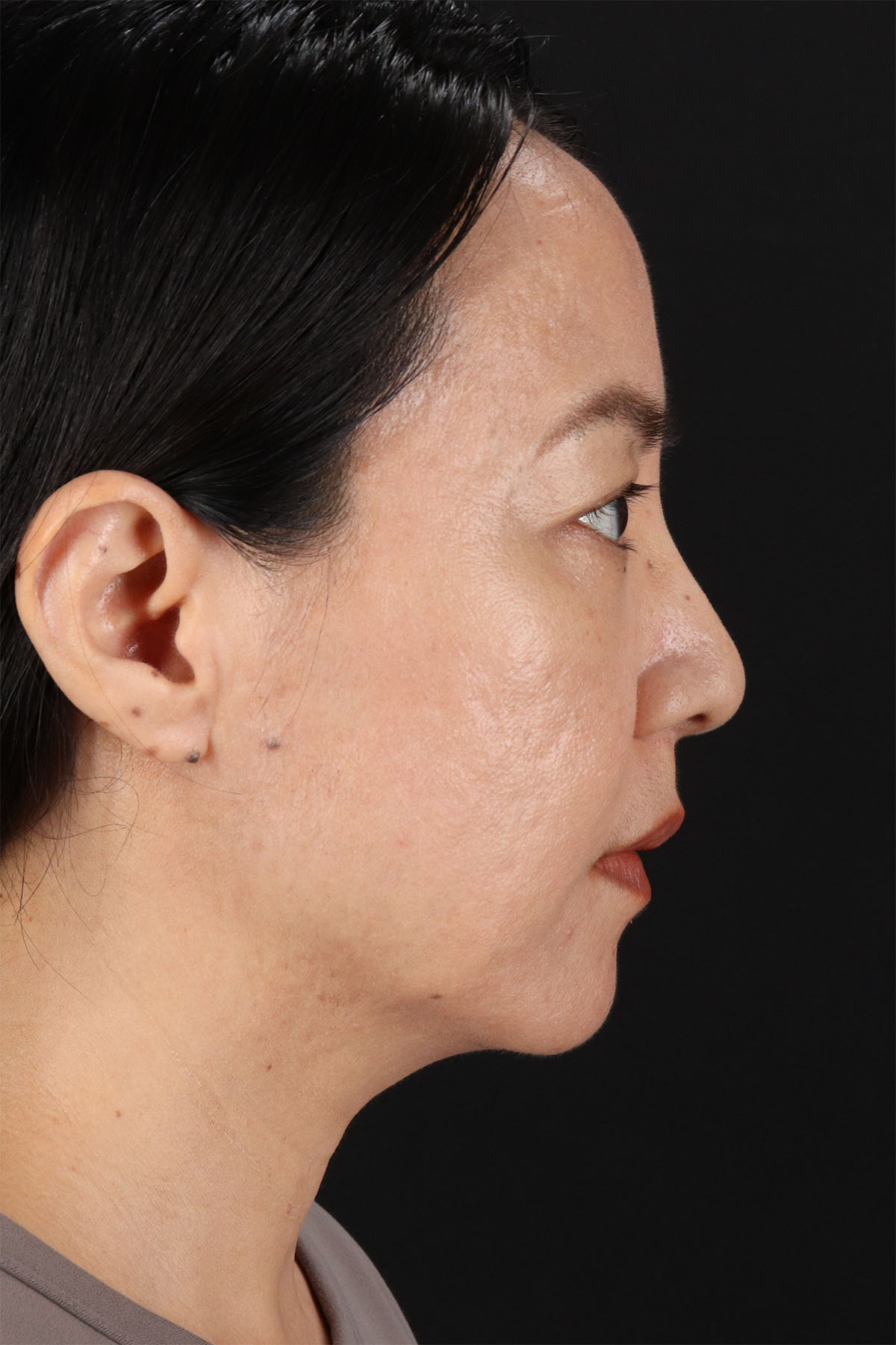 CO2 Laser Before & After Patient #11059