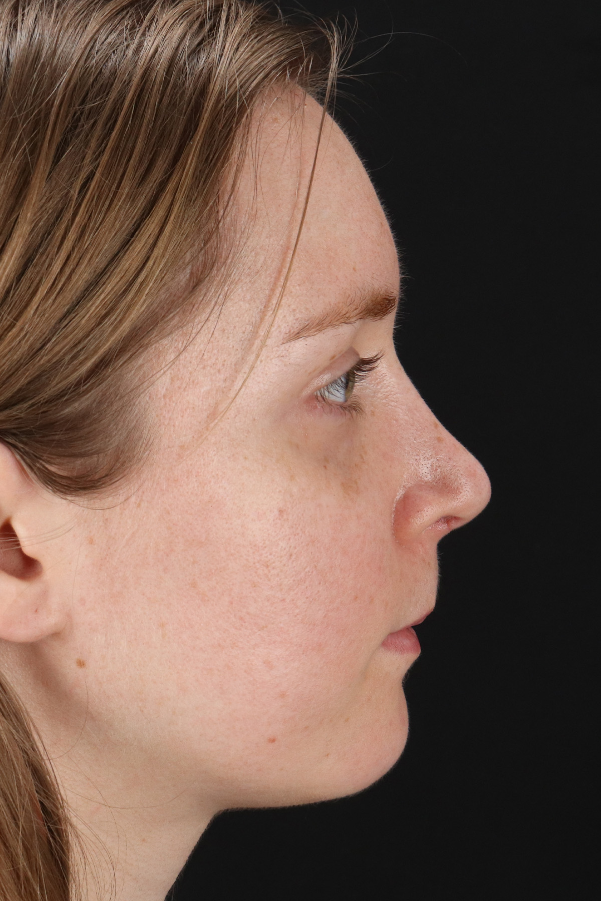 Rhinoplasty Before & After Patient #12238
