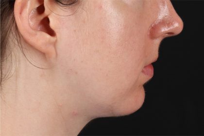 Chin Implant Before & After Patient #13761