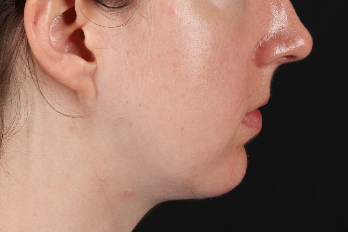 Chin Implant Before & After Patient #13761