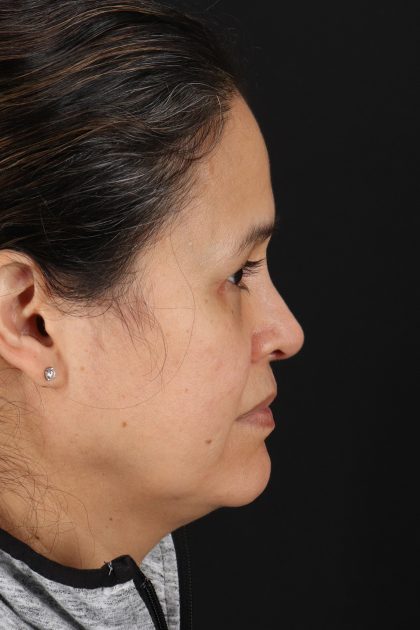Rhinoplasty Before & After Patient #12205