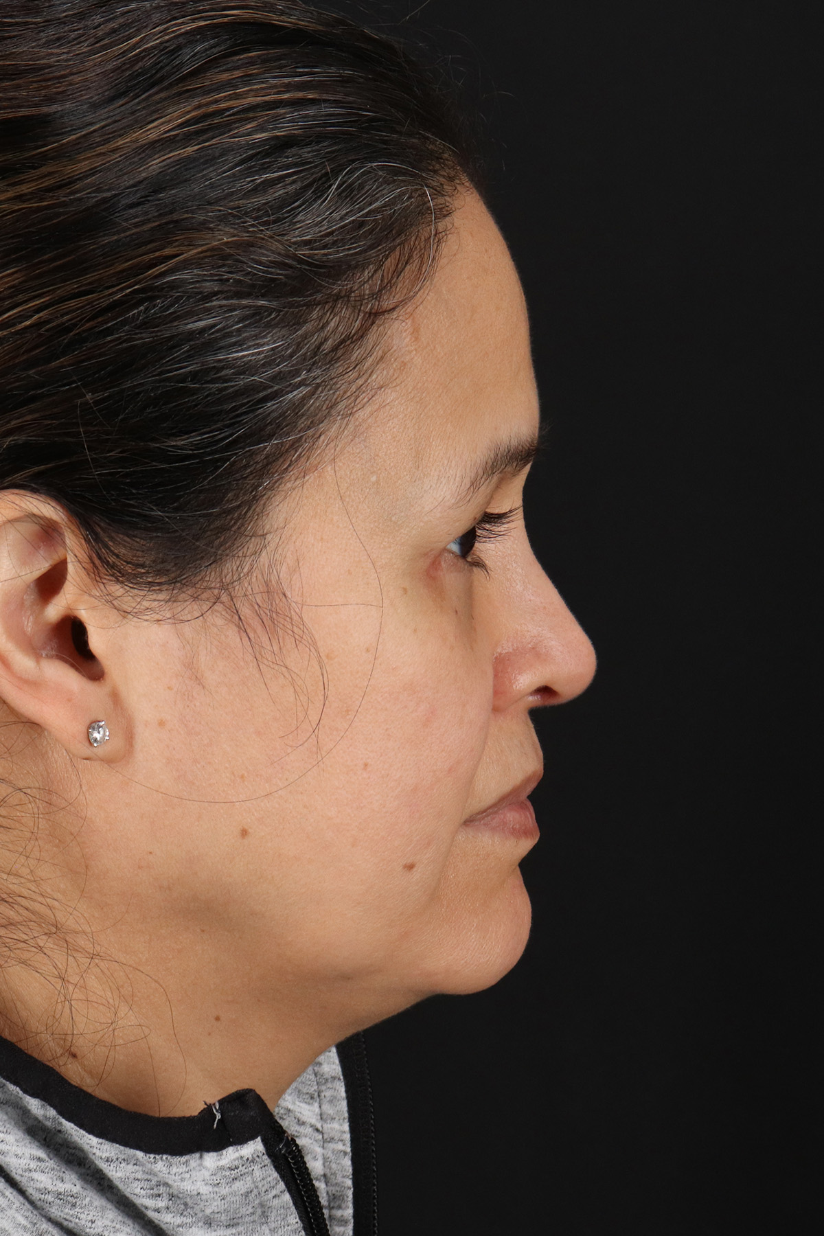 Upper Blepharoplasty Before & After Patient #12018