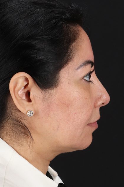 Buccal Fat Pad Before & After Patient #14014