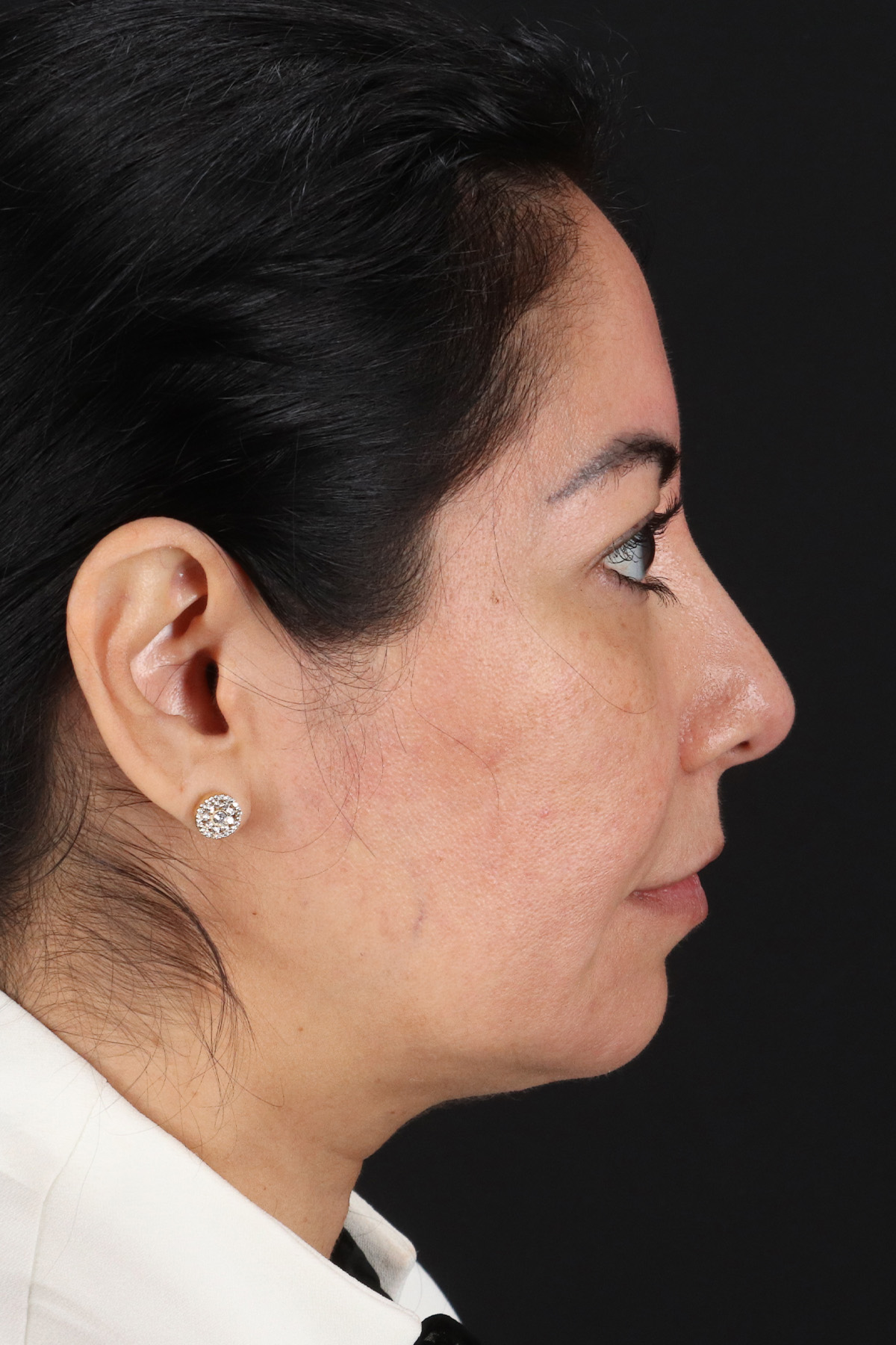 Buccal Fat Pad Before & After Patient #14014