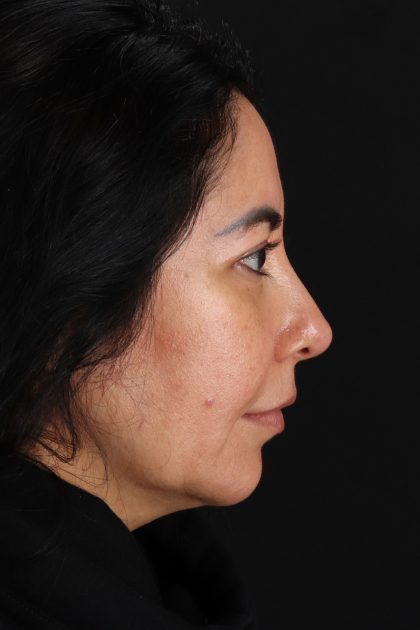 Upper Blepharoplasty Before & After Patient #12062