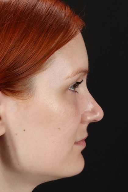 Lower Blepharoplasty Before & After Patient #13008