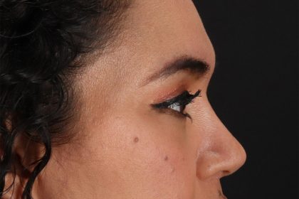 Upper Blepharoplasty Before & After Patient #12007