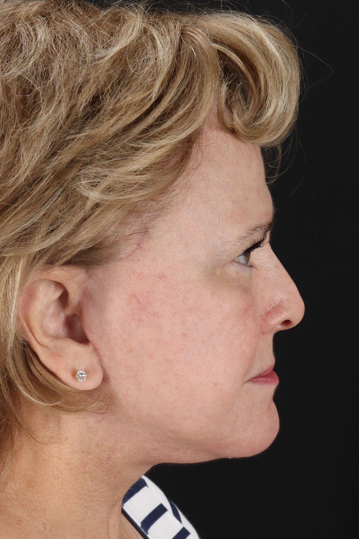 Facelift Before & After Patient #11695