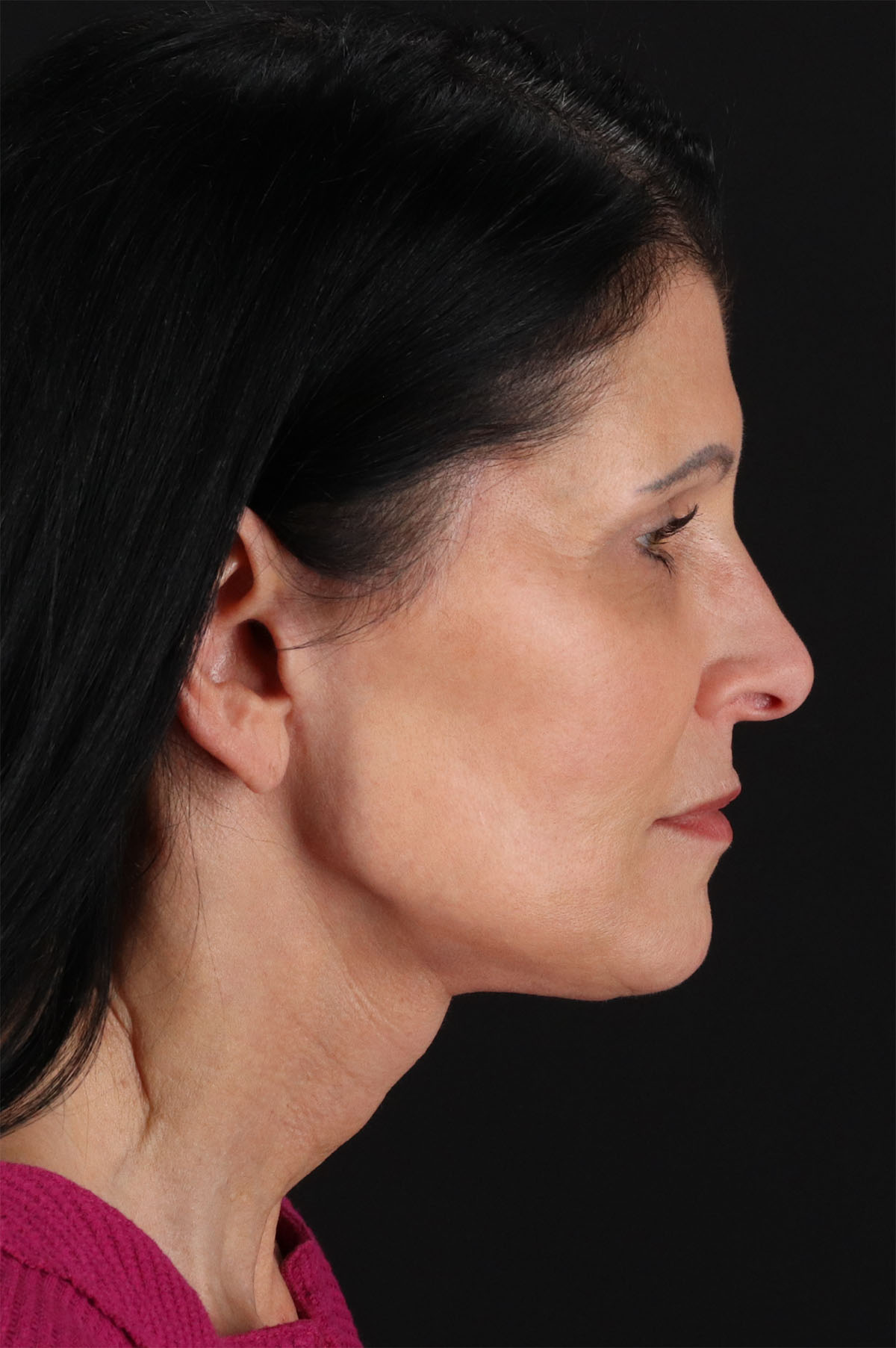 Neck Lift Before & After Patient #12887