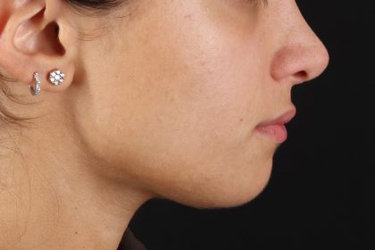 Chin Implant Before & After Patient #13750