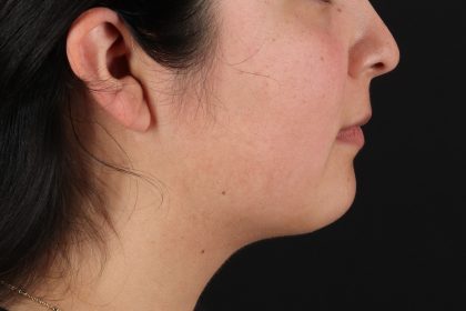 Neck Liposuction Before & After Patient #12106