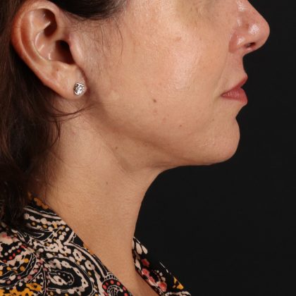 Neck Lift Before & After Patient #12953