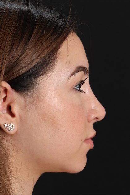 Rhinoplasty Before & After Patient #12271