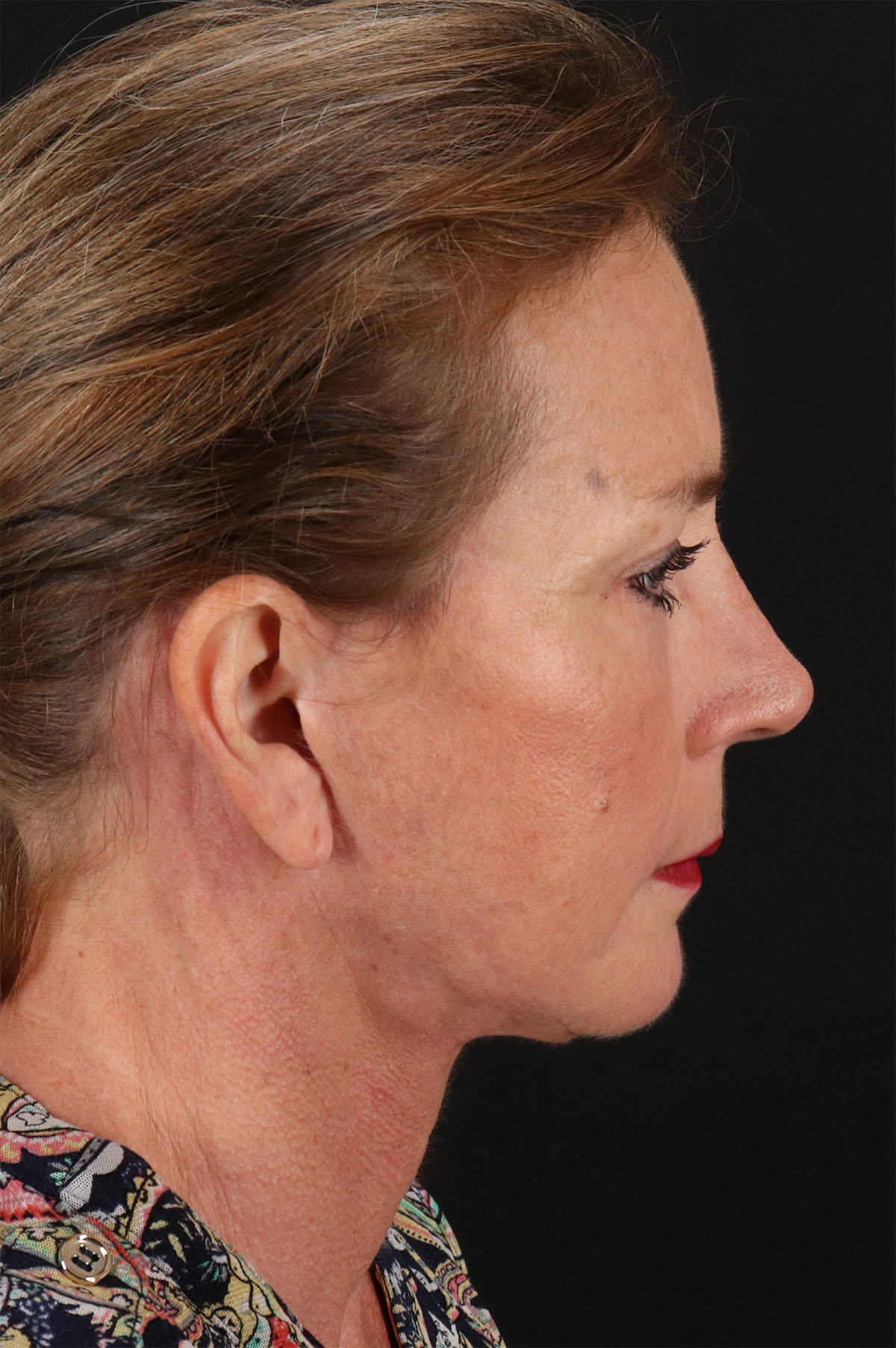 Rhinoplasty Before & After Patient #12315