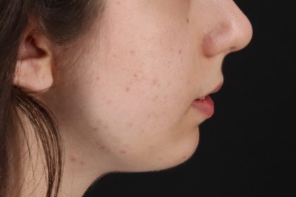 Chin Implant Before & After Patient #13772