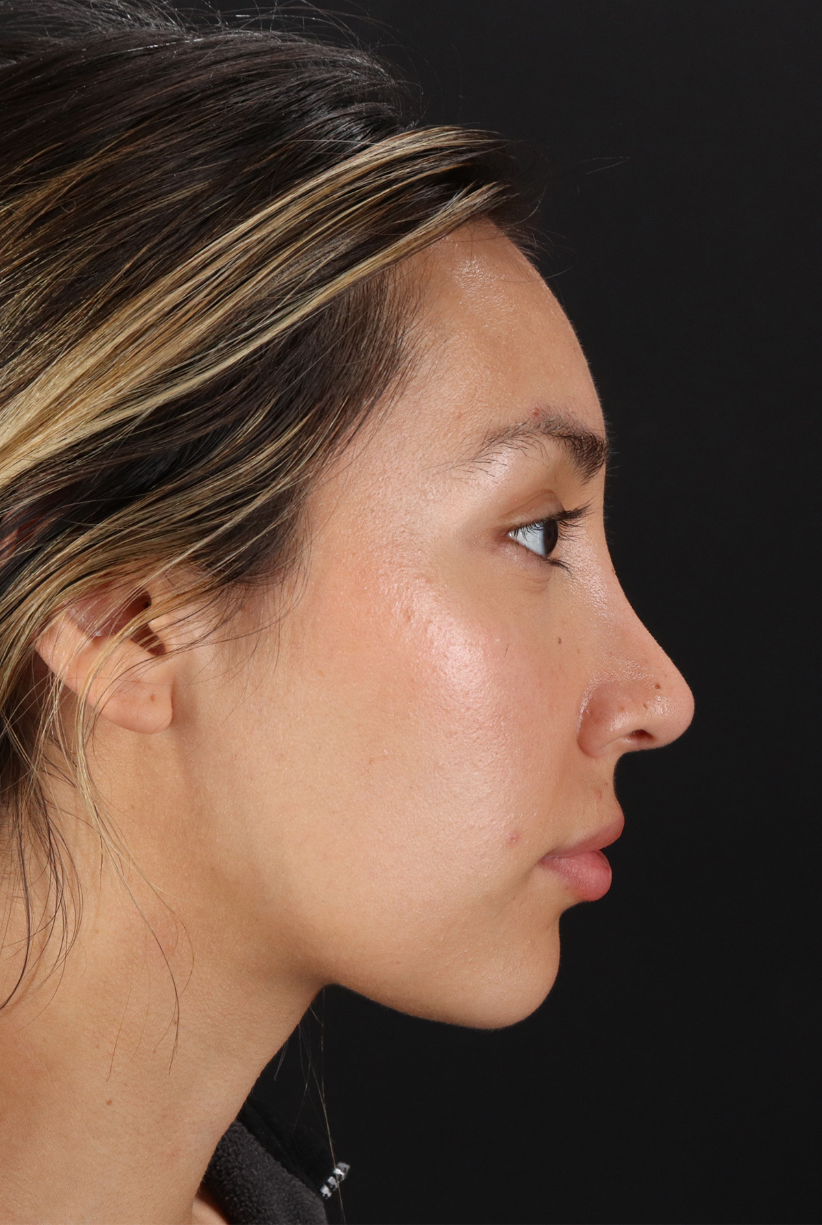 Rhinoplasty Before & After Patient #12480