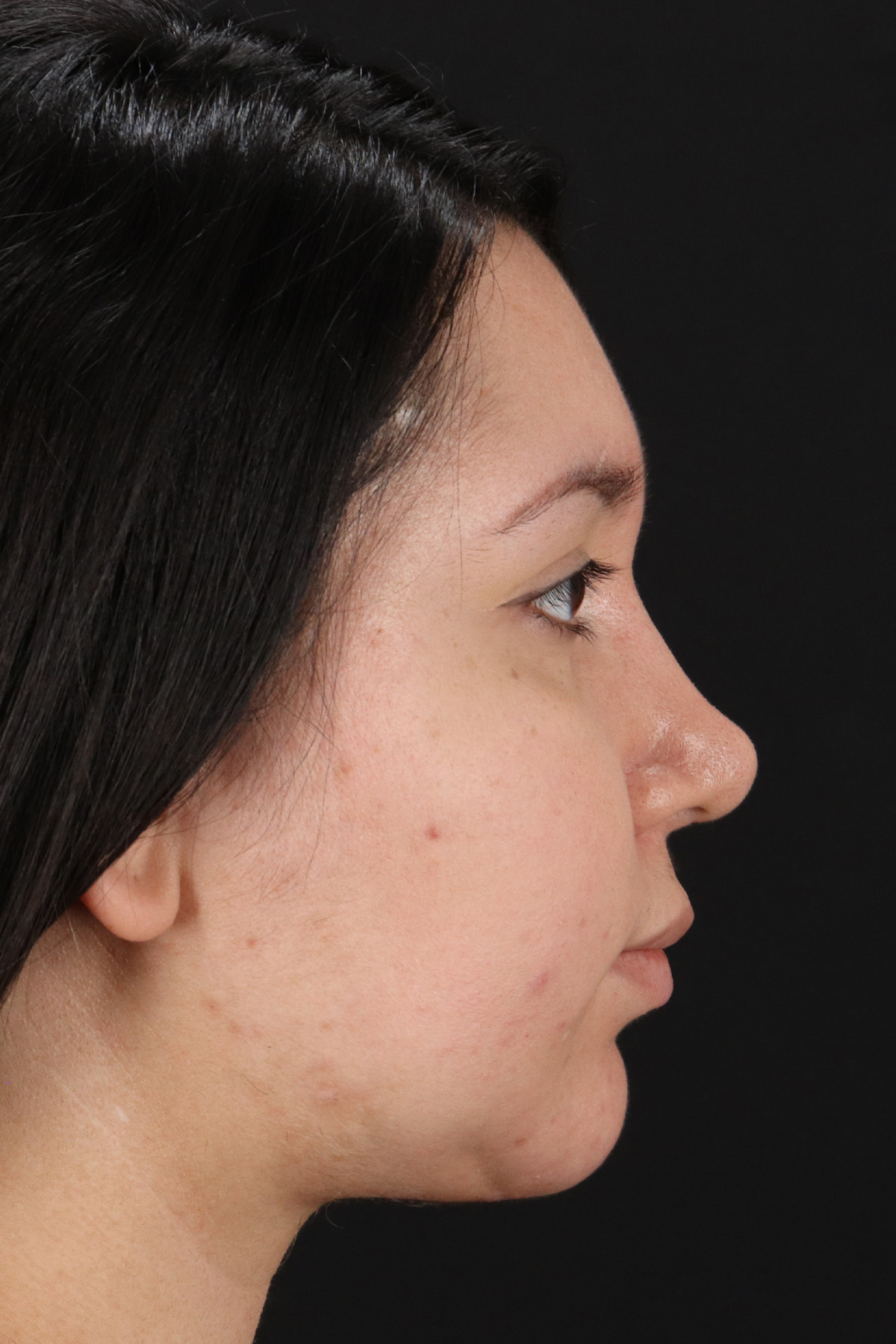 Chin Implant Before & After Patient #13739