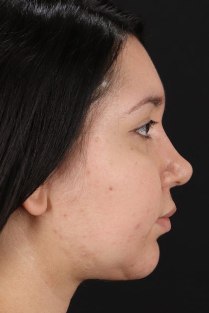 Neck Lift Before & After Patient #11698