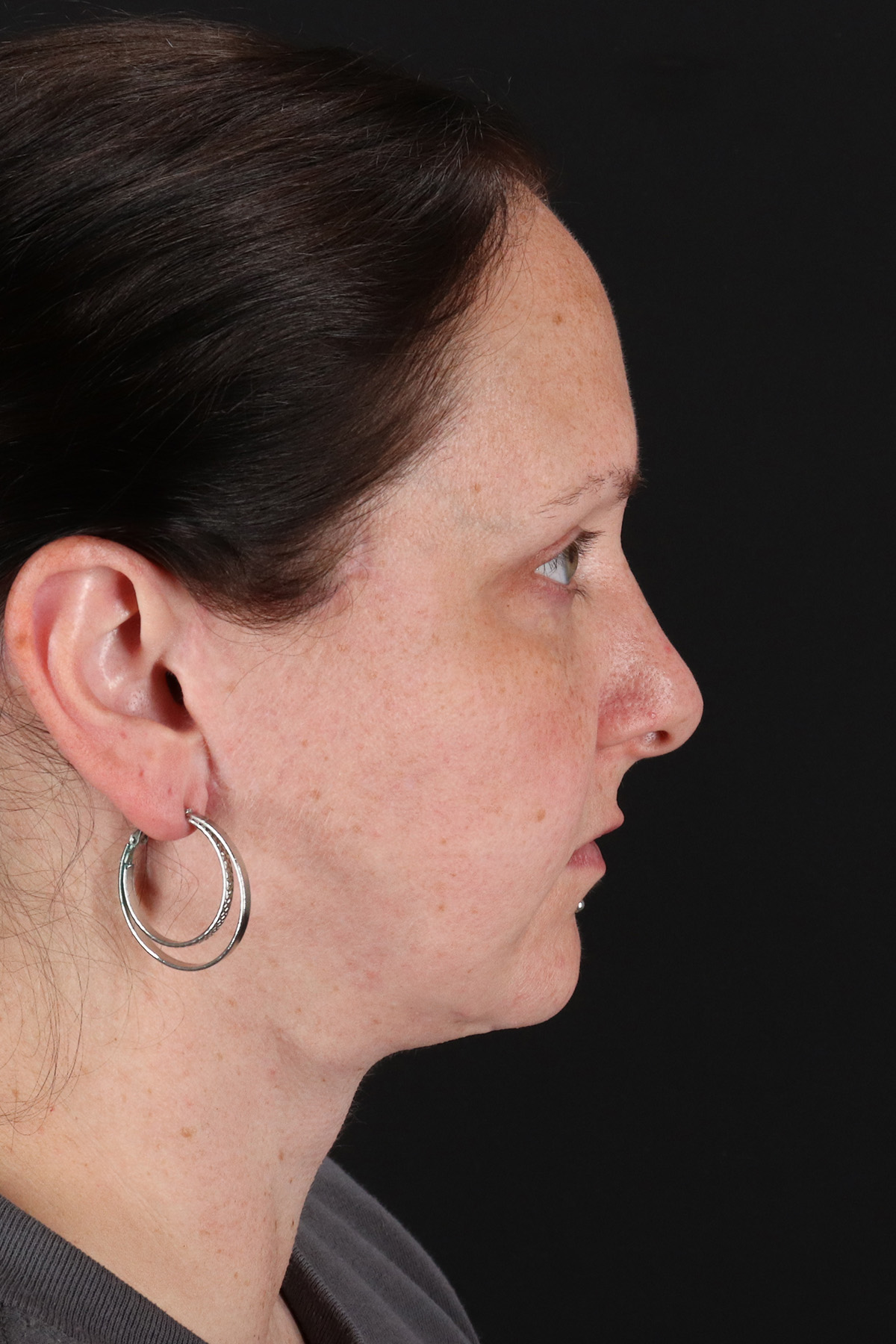 Lower Blepharoplasty Before & After Patient #13052