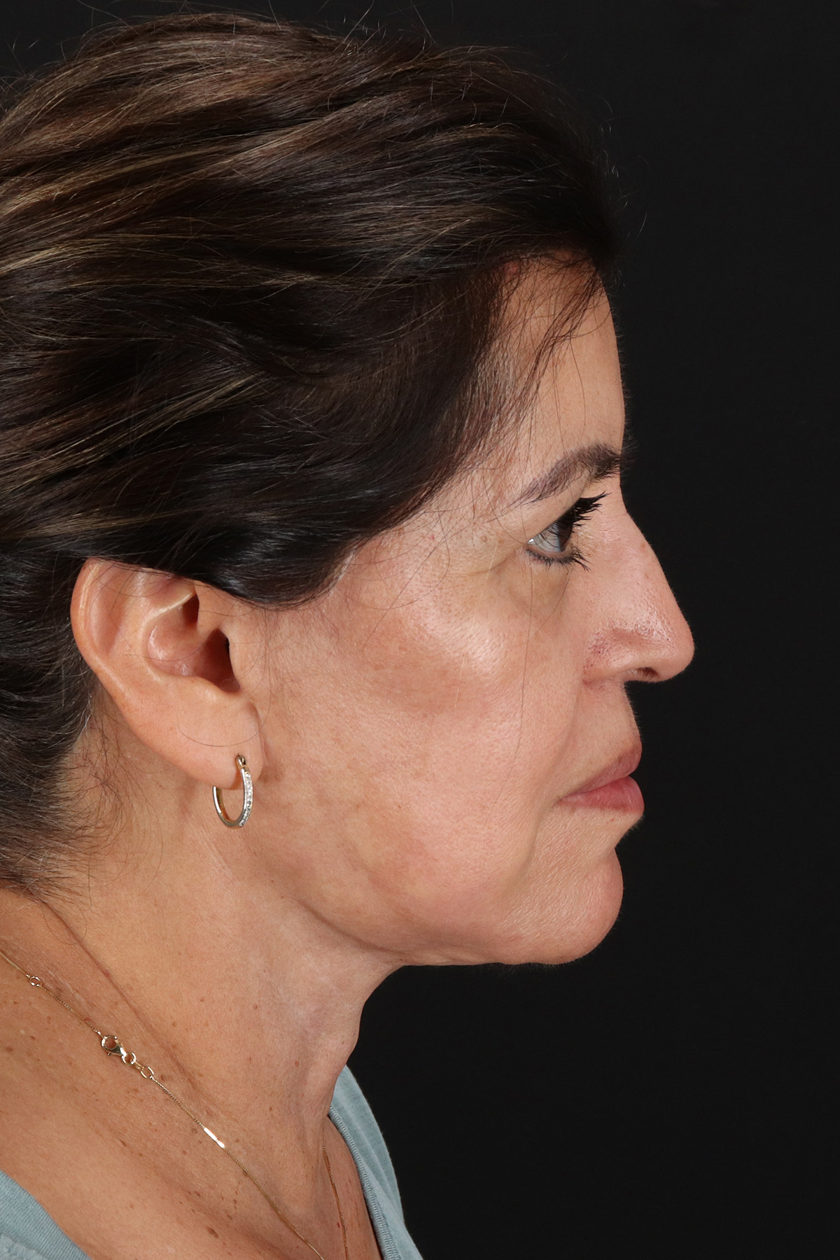 Lower Blepharoplasty Before & After Patient #13063