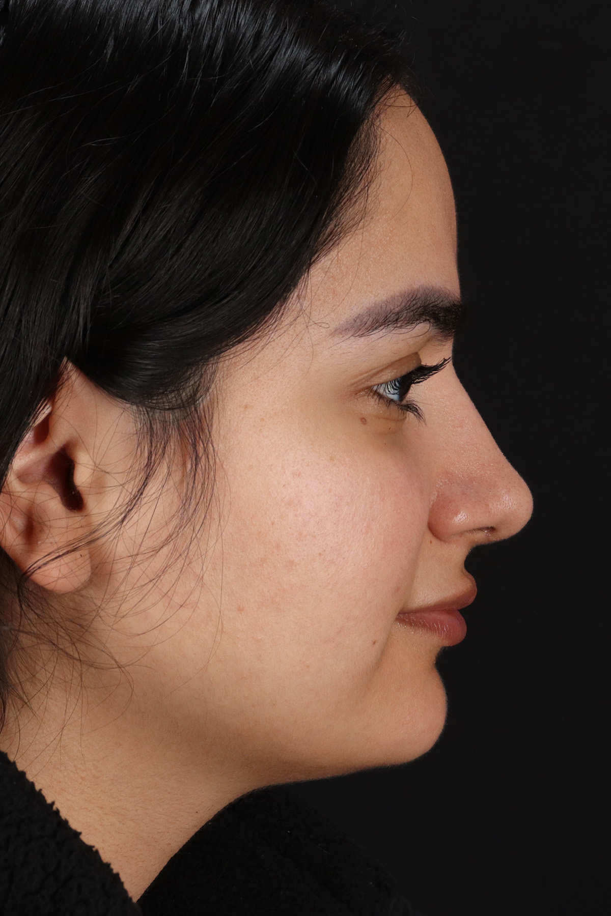 Rhinoplasty Before & After Patient #12436