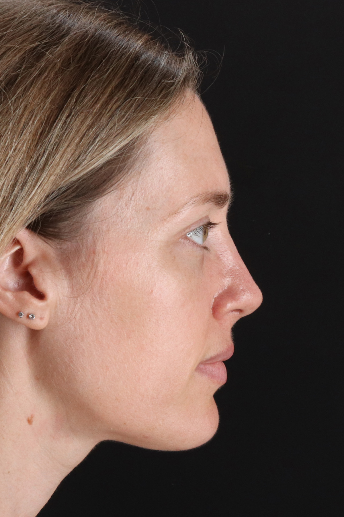 Rhinoplasty Before & After Patient #12227