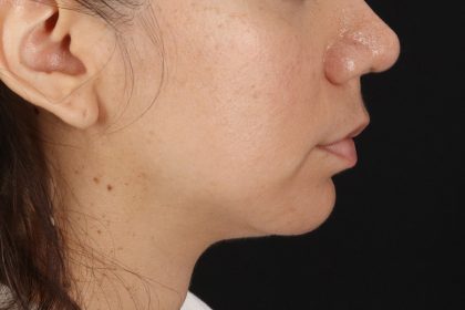 Chin Implant Before & After Patient #13783