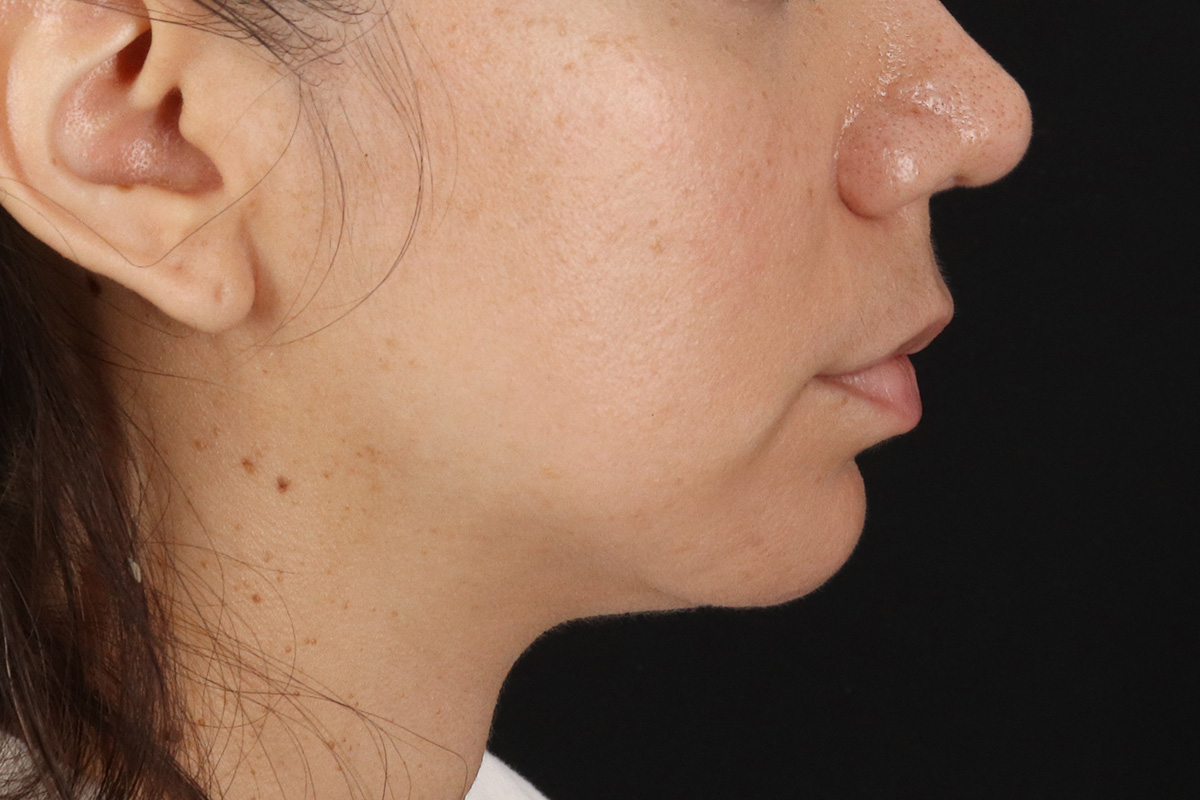 Chin Implant Before & After Patient #13783