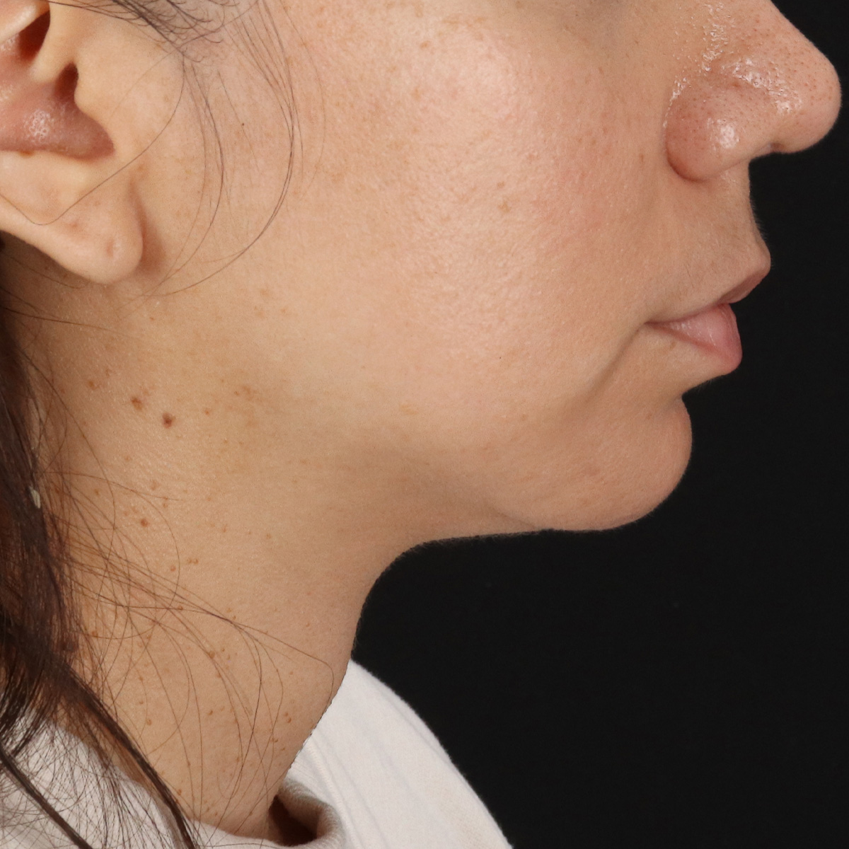 Facelift Before & After Patient #11699