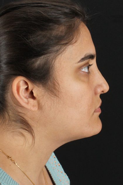 Neck Lift Before & After Patient #11565