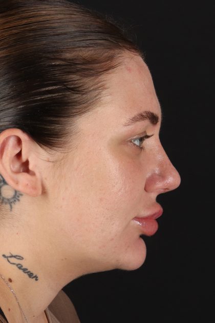 Rhinoplasty Before & After Patient #12403