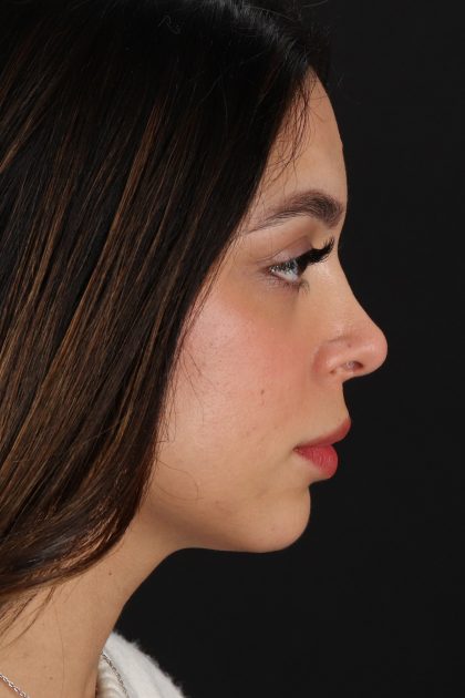 Rhinoplasty Before & After Patient #12249
