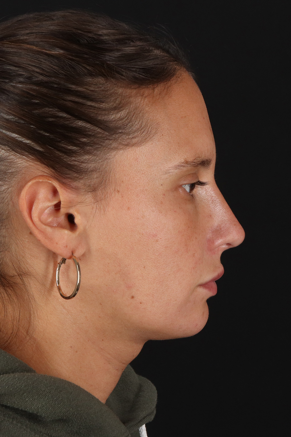 Chin Implant Before & After Patient #13728