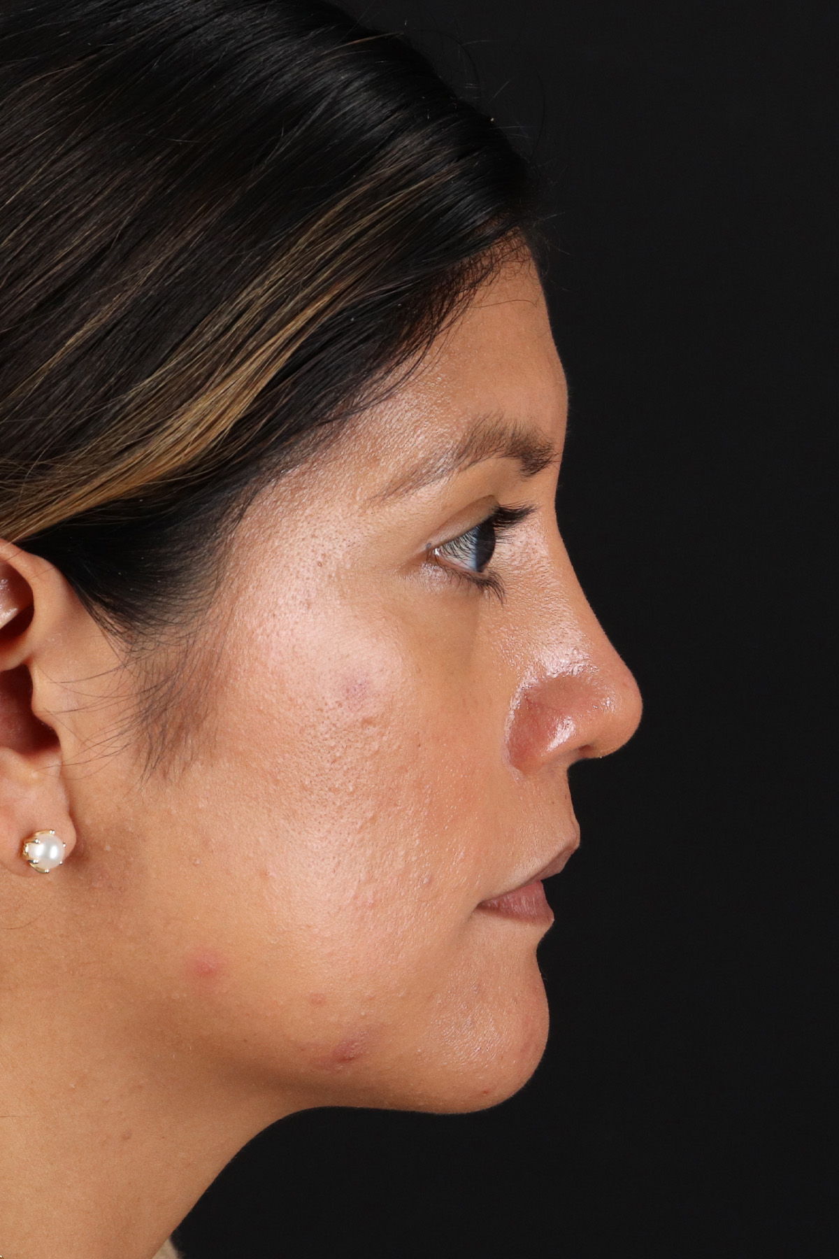 Rhinoplasty Before & After Patient #12337