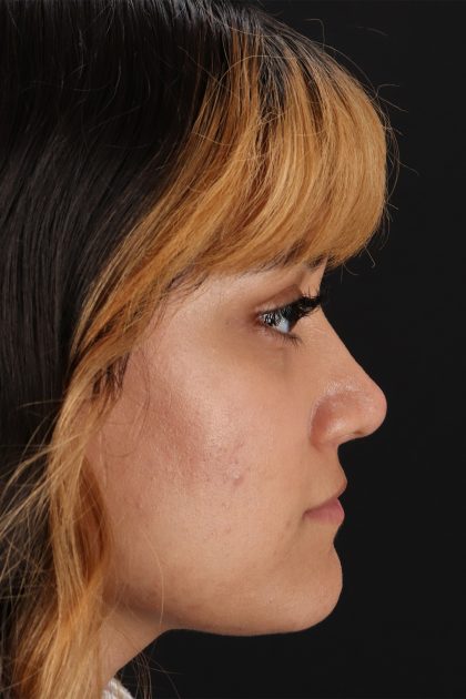 Rhinoplasty Before & After Patient #12469