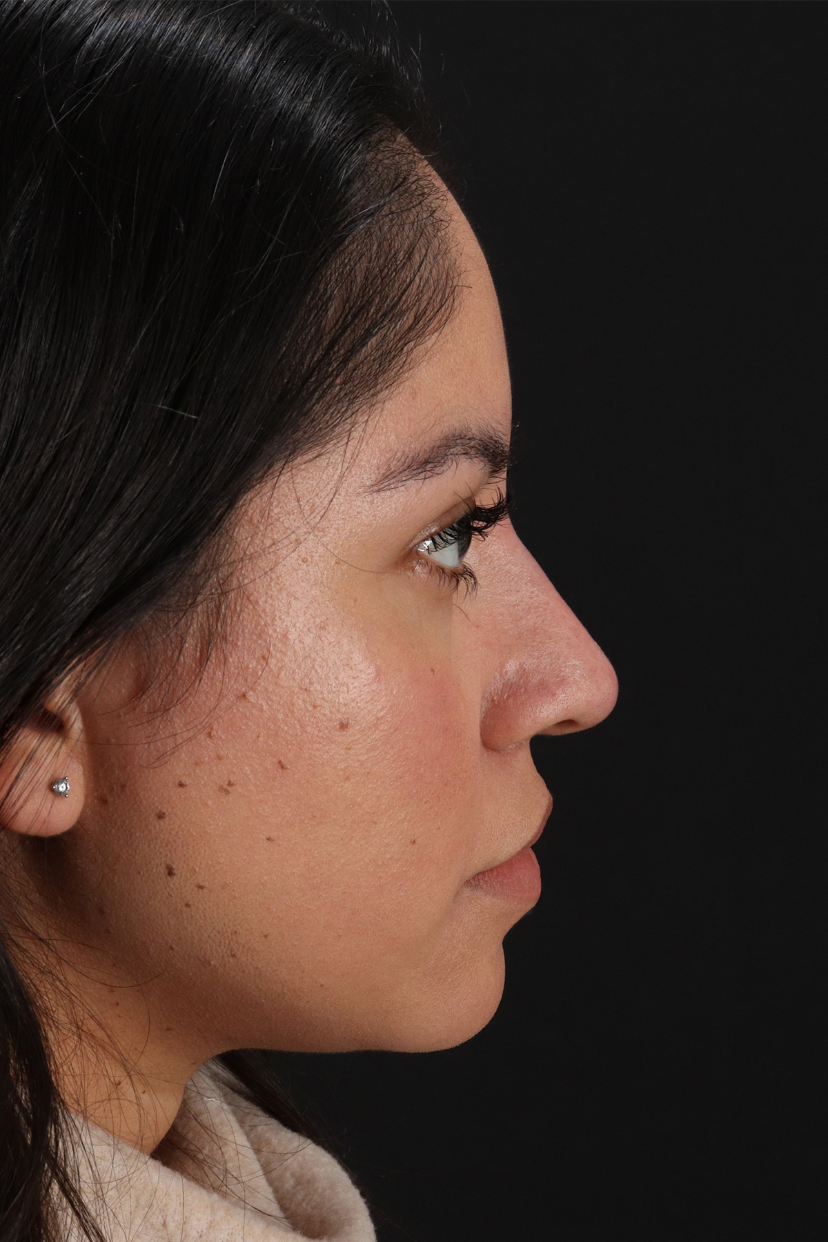 Fillers Before & After Patient #13276