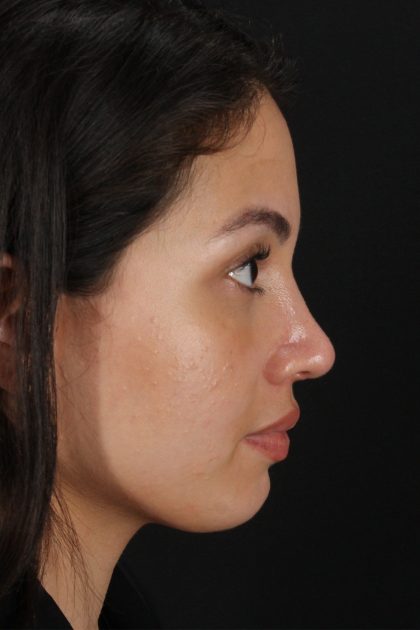 Rhinoplasty Before & After Patient #12282