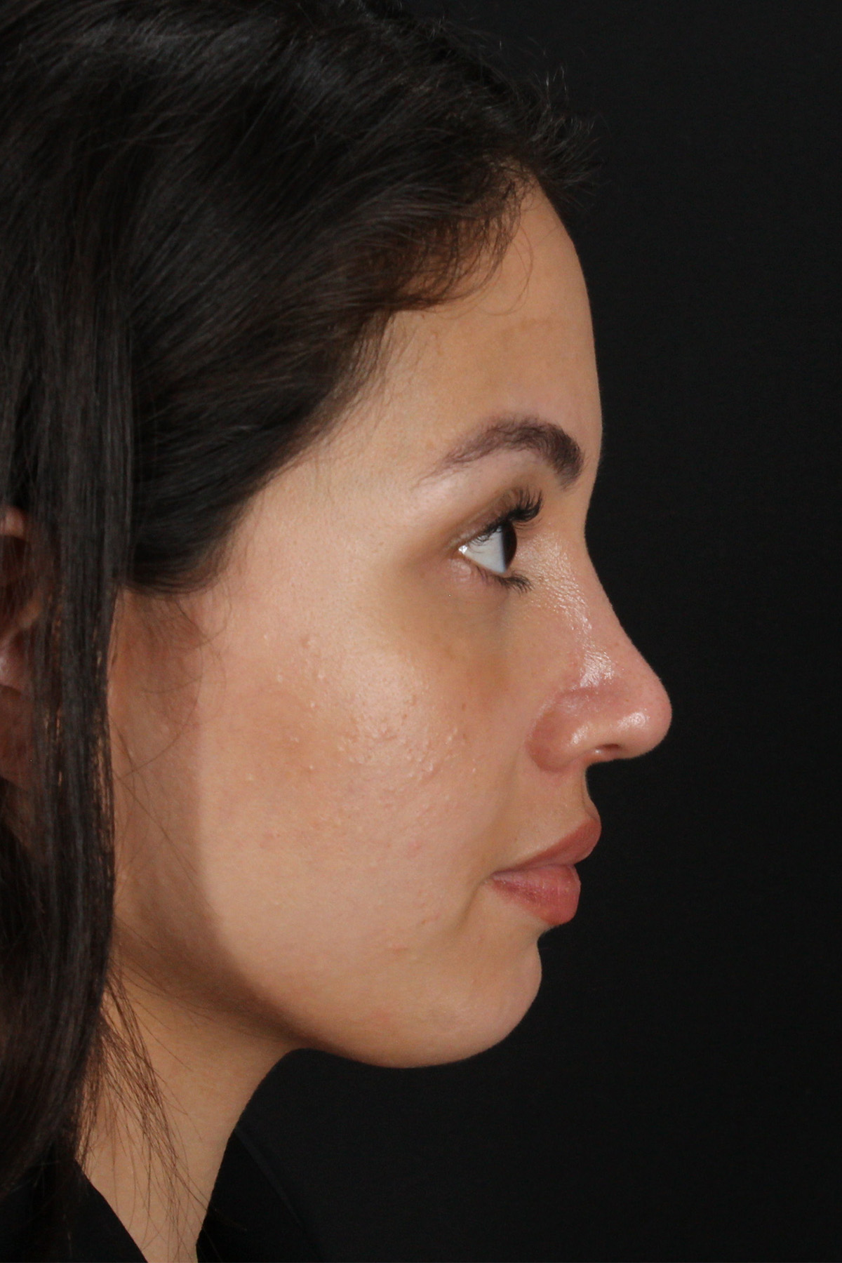 Rhinoplasty Before & After Patient #12282